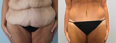 Body Lift Before & After Gallery - Patient 47252993 - Image 1