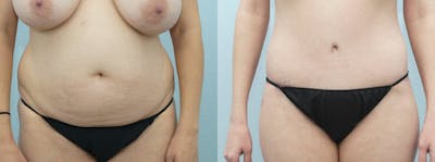 Body Lift Before & After Gallery - Patient 47252994 - Image 1