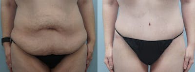Body Lift Before & After Gallery - Patient 47252995 - Image 1