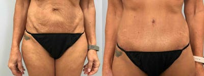 Body Lift Before & After Gallery - Patient 47252998 - Image 1