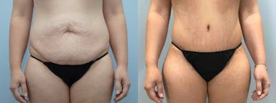 Body Lift Before & After Gallery - Patient 47253051 - Image 1