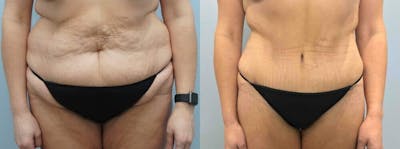 Body Lift Before & After Gallery - Patient 47253100 - Image 1