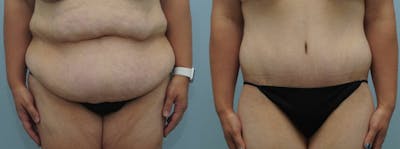 Body Lift Before & After Gallery - Patient 47253105 - Image 1