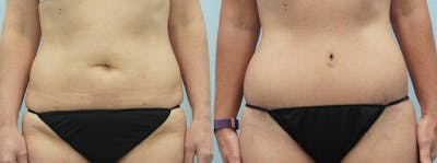 Body Lift Before & After Gallery - Patient 47253108 - Image 1