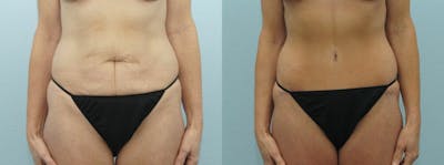 Body Lift Before & After Gallery - Patient 47253109 - Image 1