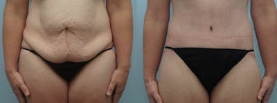 Body Lift Before & After Gallery - Patient 47253114 - Image 1