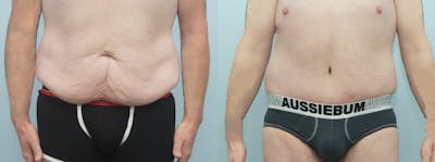 Body Lift Before & After Gallery - Patient 53582937 - Image 1