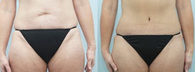 Body Lift Before & After Gallery - Patient 47253120 - Image 1