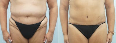 Body Lift Before & After Gallery - Patient 47253122 - Image 1