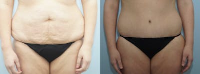 Body Lift Before & After Gallery - Patient 47253230 - Image 1