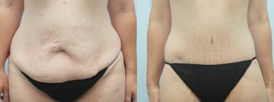 Body Lift Before & After Gallery - Patient 47253401 - Image 1