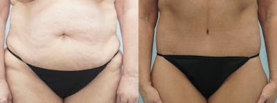 Body Lift Before & After Gallery - Patient 47253562 - Image 1