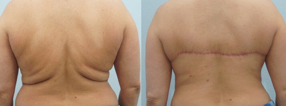 Bra Line Back Lift