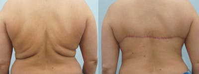 Bra Line Back Lift Before & After Gallery - Patient 47253650 - Image 1