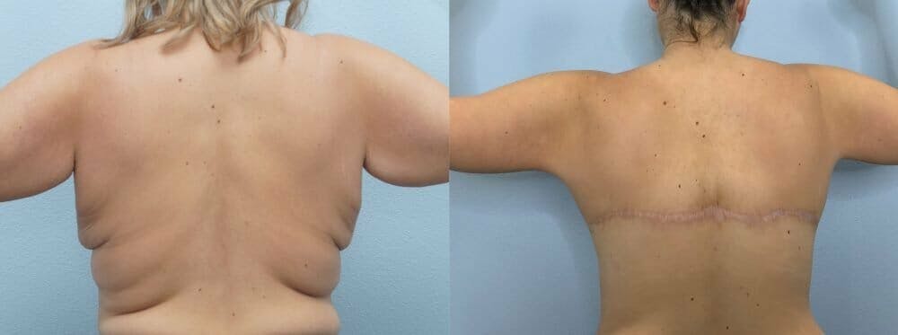 Bra Line Back Lift