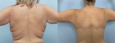 Bra Line Back Lift Before & After Gallery - Patient 47253651 - Image 1