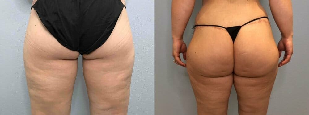 Brazilian Butt Lift