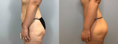 Brazilian Butt Lift Before & After Gallery - Patient 47253661 - Image 1