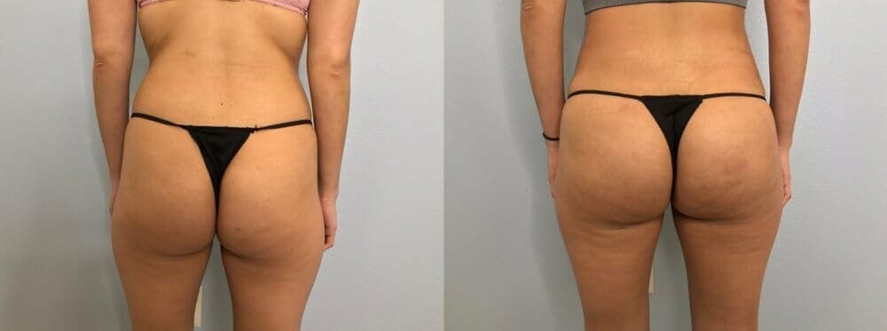 Brazilian Butt Lift