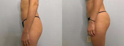 Brazilian Butt Lift Before & After Gallery - Patient 47253663 - Image 1