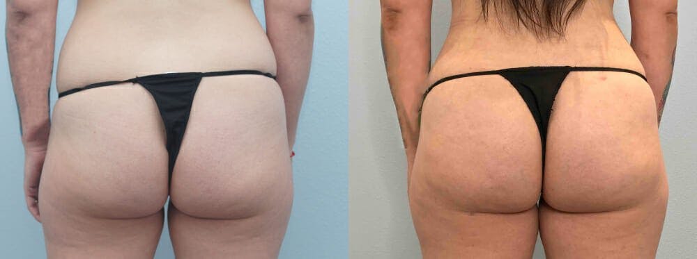 Brazilian Butt Lift