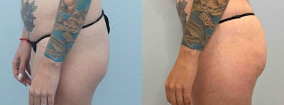 Brazilian Butt Lift Before & After Gallery - Patient 47253670 - Image 1