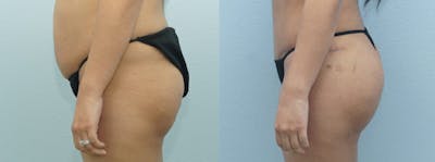 Brazilian Butt Lift Before & After Gallery - Patient 47253674 - Image 1