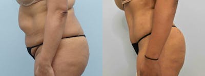 Brazilian Butt Lift Before & After Gallery - Patient 47253680 - Image 1