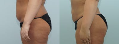 Brazilian Butt Lift Before & After Gallery - Patient 47253683 - Image 1