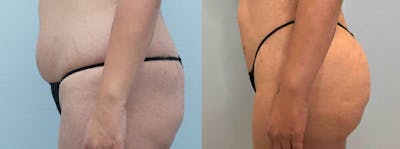 Brazilian Butt Lift Before & After Gallery - Patient 47253703 - Image 1