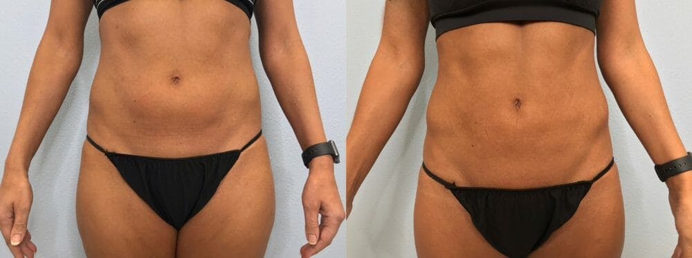 Liposuction
