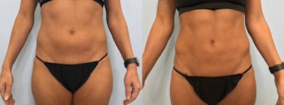Liposuction Before & After Gallery - Patient 47253737 - Image 1