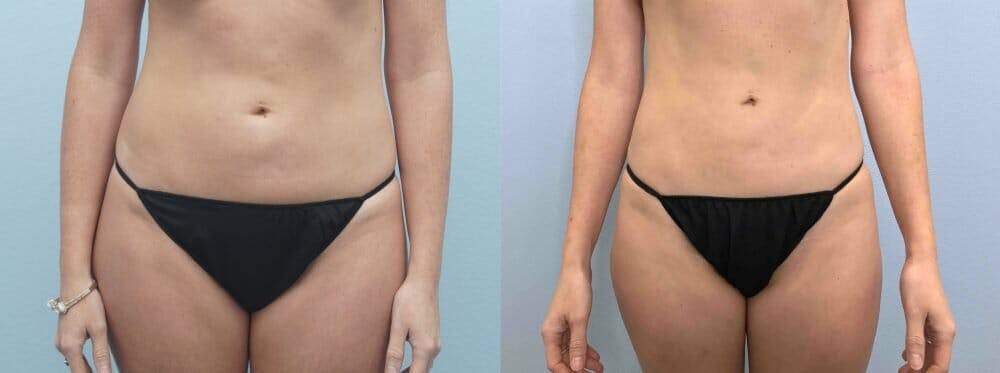 Liposuction