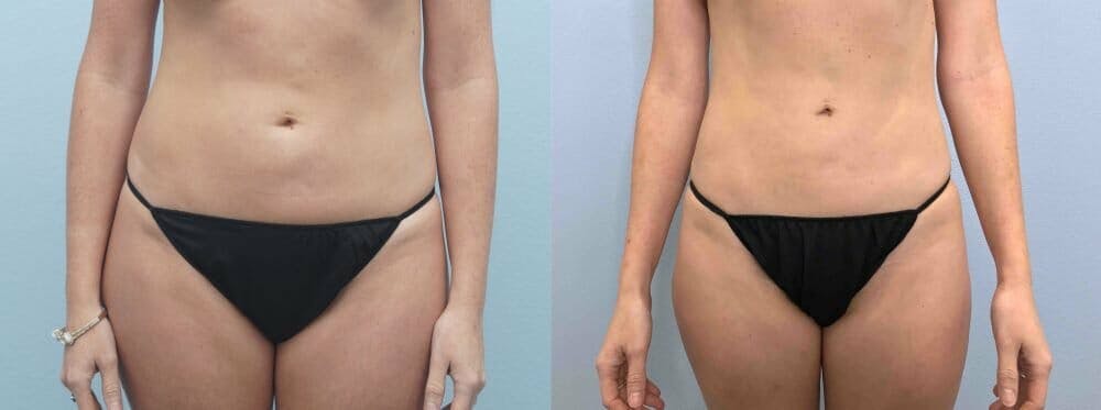 Liposuction Gallery - Patient 47253740 - Image 1