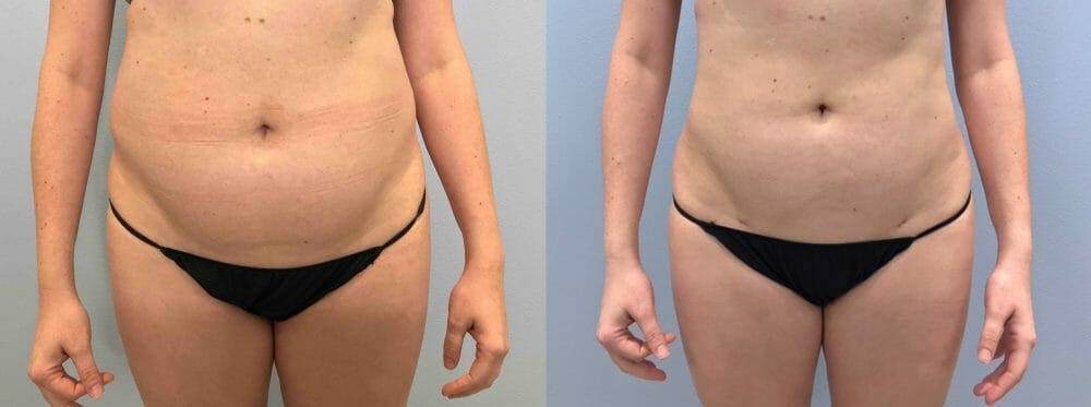 Liposuction Gallery - Patient 47253742 - Image 1