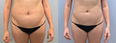 Liposuction Before & After Gallery - Patient 47253742 - Image 1