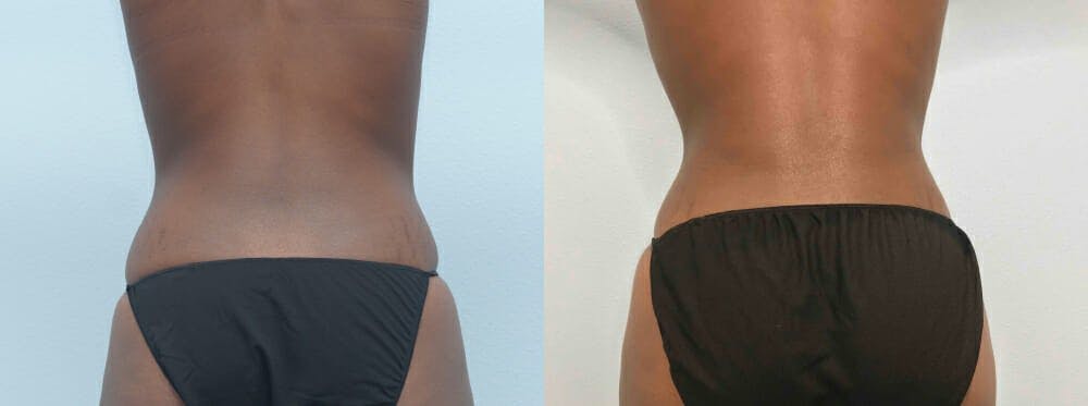 Liposuction Gallery - Patient 47253761 - Image 1