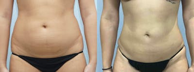 Liposuction Before & After Gallery - Patient 47253763 - Image 1