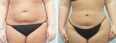 Liposuction Before & After Gallery - Patient 47253767 - Image 1