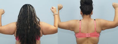 Liposuction Before & After Gallery - Patient 47253769 - Image 1