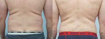 Liposuction Before & After Gallery - Patient 53590602 - Image 1