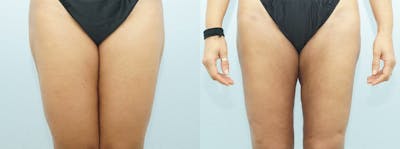 Liposuction Before & After Gallery - Patient 47253775 - Image 1