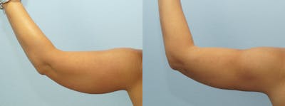 Liposuction Before & After Gallery - Patient 47253777 - Image 1