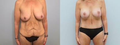Mommy Makeover Before & After Gallery - Patient 47253781 - Image 1