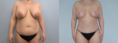 Mommy Makeover Before & After Gallery - Patient 47253791 - Image 1
