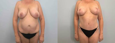 Mommy Makeover Before & After Gallery - Patient 47253799 - Image 1