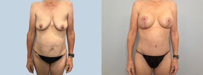 Mommy Makeover Before & After Gallery - Patient 47253810 - Image 1