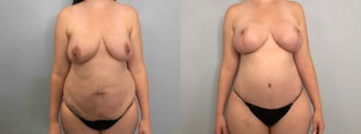 Mommy Makeover Before & After Gallery - Patient 47253812 - Image 1