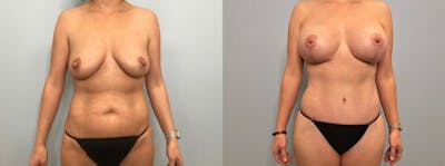 Mommy Makeover Before & After Gallery - Patient 47253824 - Image 1