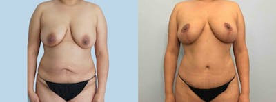 Mommy Makeover Before & After Gallery - Patient 47253834 - Image 1